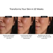 5 - TrueBasics 10% Niacinamide Skin Clarifying Serum with Zinc & Rumex Extract, 30 ml for Pigmentation, Dark Spots, Acne Marks